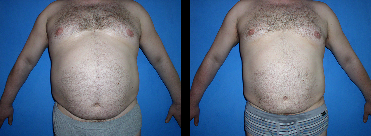 vor und nach 20 Behandlungen
